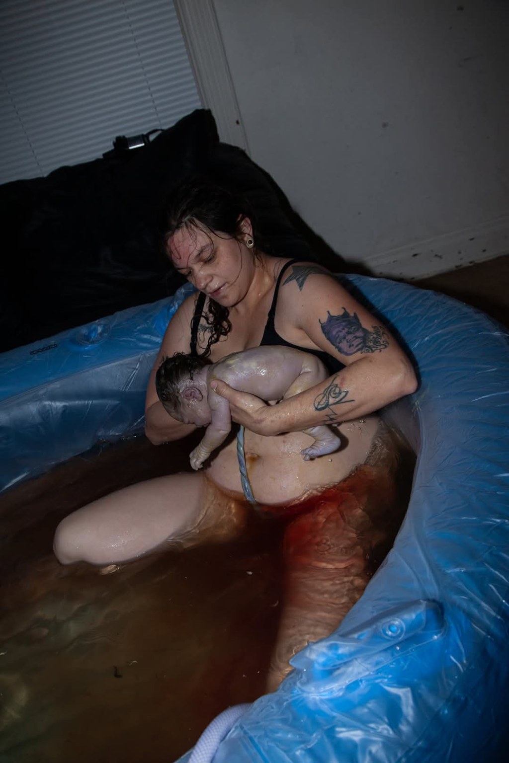 Water Birth, Double Nuchal Cord, Meconium-Stained
